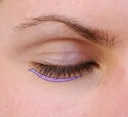 Lower eyelid blepharoplasty marking